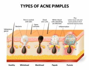 Tipi di acne - schema